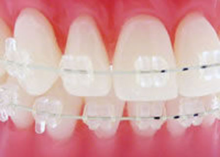 APARAT DENTAR TRANSPARENT