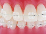 APARAT DENTAR TRANSPARENT